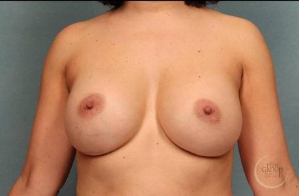 Breast Augmentation Before & After Patient #8669