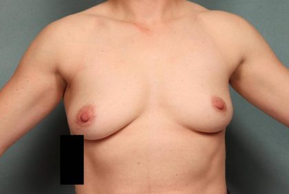 Breast Augmentation Before & After Patient #8670