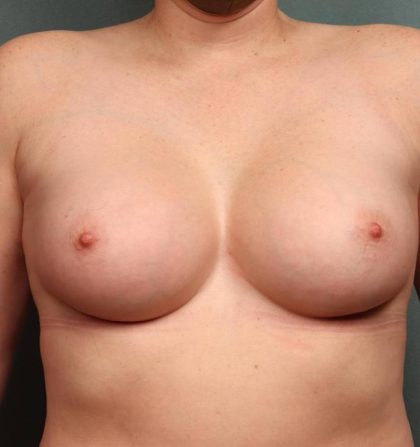 Breast Augmentation Before & After Patient #8562