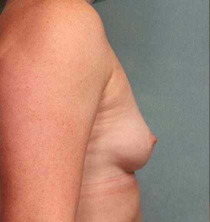 Breast Augmentation Before & After Patient #8562