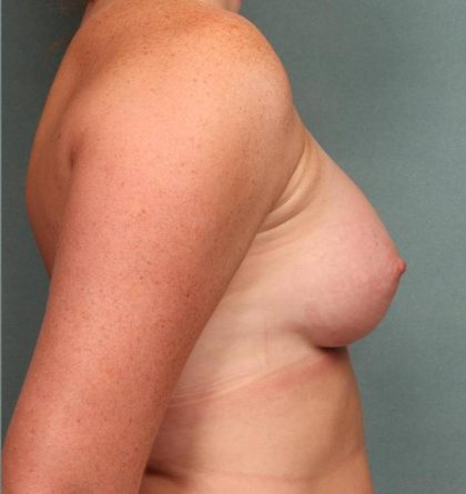 Breast Augmentation Before & After Patient #8562