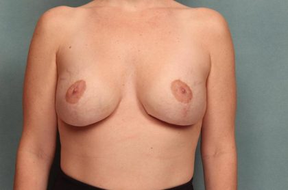 Breast Augmentation Before & After Patient #8563