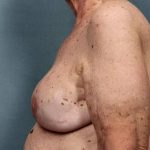 Breast Reconstruction Before & After Patient #8802