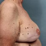 Breast Reconstruction Before & After Patient #8802