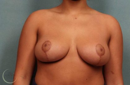 Breast Reduction Before & After Patient #8791