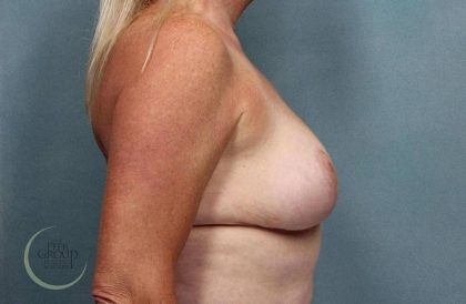 Breast Reduction Before & After Patient #8792