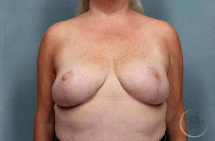 Breast Reduction Before & After Patient #8792