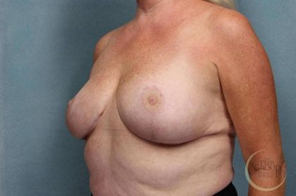 Breast Reduction Before & After Patient #8792