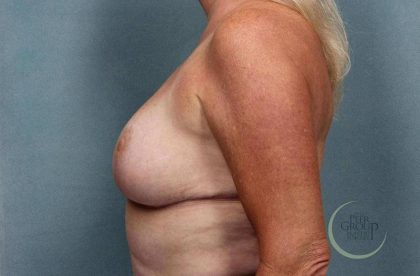Breast Reduction Before & After Patient #8792