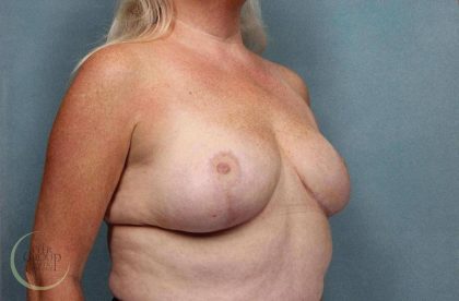Breast Reduction Before & After Patient #8792