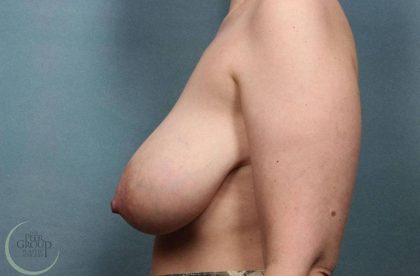 Breast Reduction Before & After Patient #8793