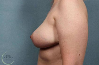 Breast Reduction Before & After Patient #8793