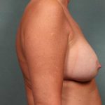 Breast Revision Before & After Patient #8798