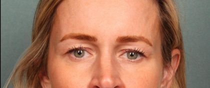Brow Lift Before & After Patient #8871
