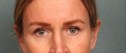 Brow Lift Before & After Patient #8871