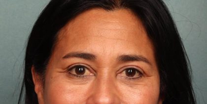 Brow Lift Before & After Patient #8872