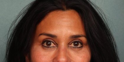 Brow Lift Before & After Patient #8872