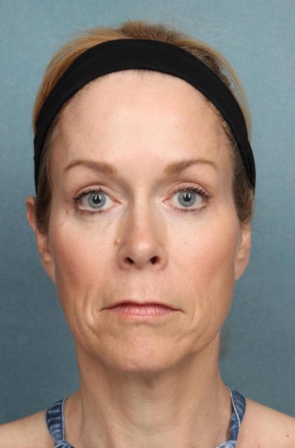Brow Lift Before & After Patient #8873