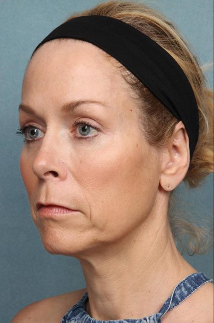 Brow Lift Before & After Patient #8873