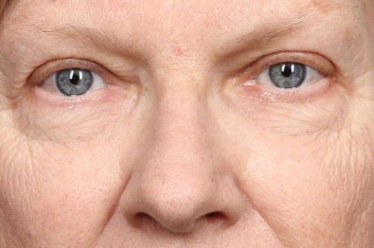 Brow Lift Before & After Patient #8874