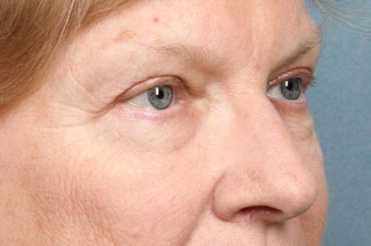 Brow Lift Before & After Patient #8874