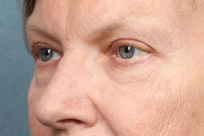 Brow Lift Before & After Patient #8874
