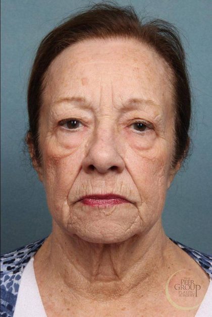 Brow Lift Before & After Patient #8875