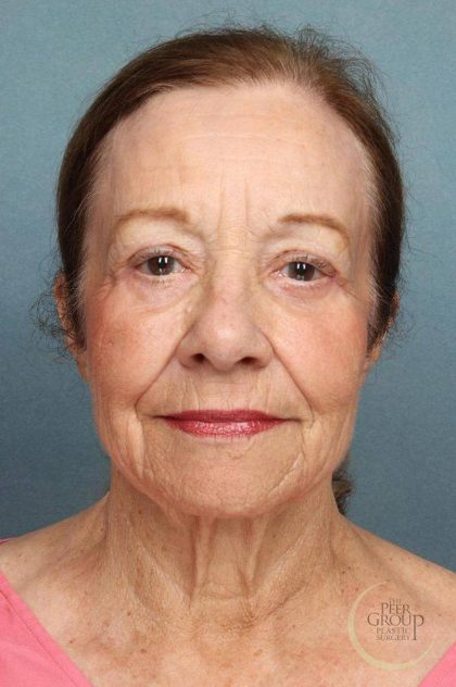 Brow Lift Before & After Patient #8875