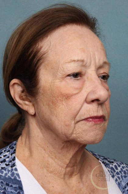 Brow Lift Before & After Patient #8875