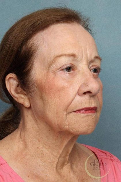 Brow Lift Before & After Patient #8875