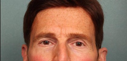 Brow Lift Before & After Patient #8876