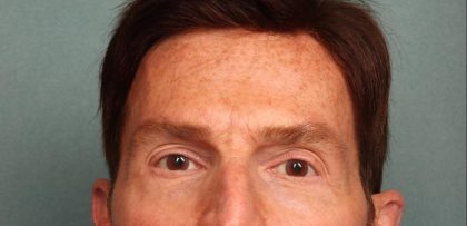 Brow Lift Before & After Patient #8876