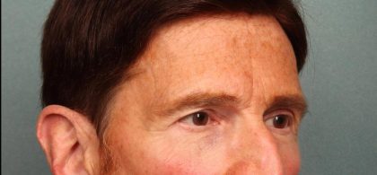 Brow Lift Before & After Patient #8876