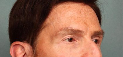 Brow Lift Before & After Patient #8876