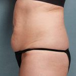 Coolsculpting Before & After Patient #9103