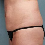 Coolsculpting Before & After Patient #9103
