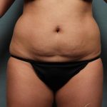 Coolsculpting Before & After Patient #9104