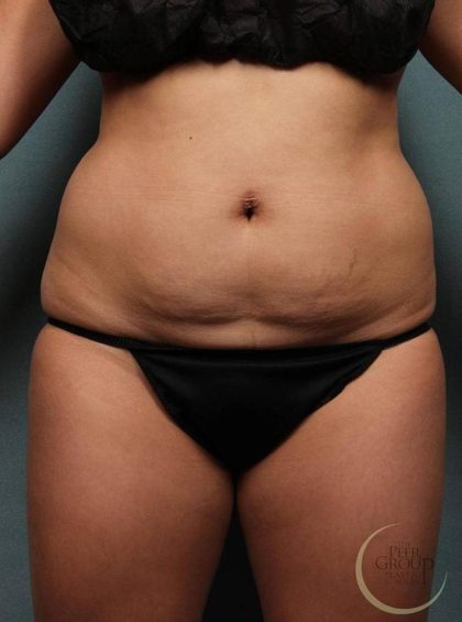 Coolsculpting Before & After Patient #9104
