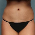 Coolsculpting Before & After Patient #9104