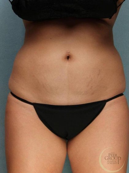 Coolsculpting Before & After Patient #9104