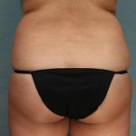 Coolsculpting Before & After Patient #9104