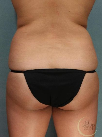 Coolsculpting Before & After Patient #9104