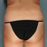 Coolsculpting Before & After Patient #9104