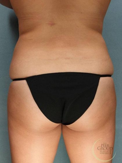 Coolsculpting Before & After Patient #9104