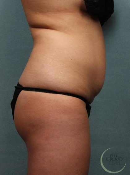 Coolsculpting Before & After Patient #9104