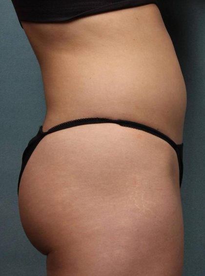 Coolsculpting Before & After Patient #9096