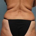 Coolsculpting Before & After Patient #9102