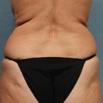 Coolsculpting Before & After Patient #9102