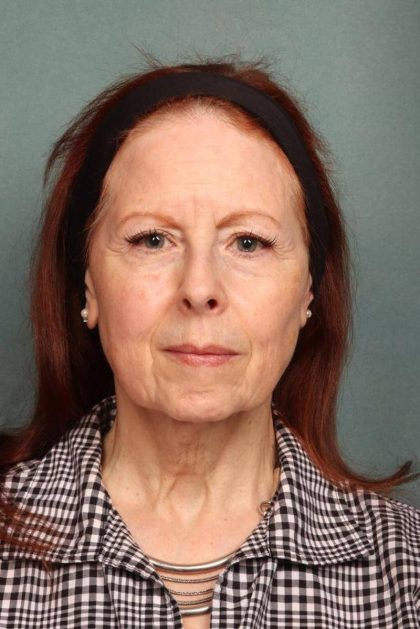 Facelift Before & After Patient #9181