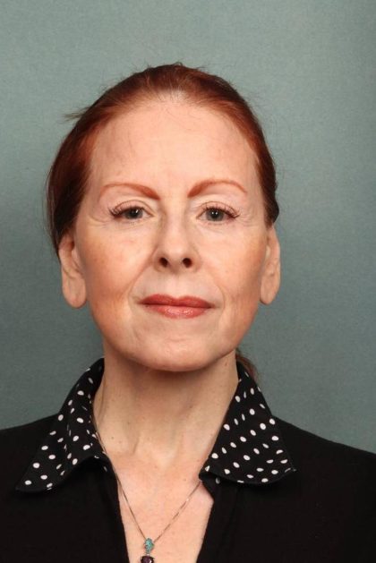 Facelift Before & After Patient #9181